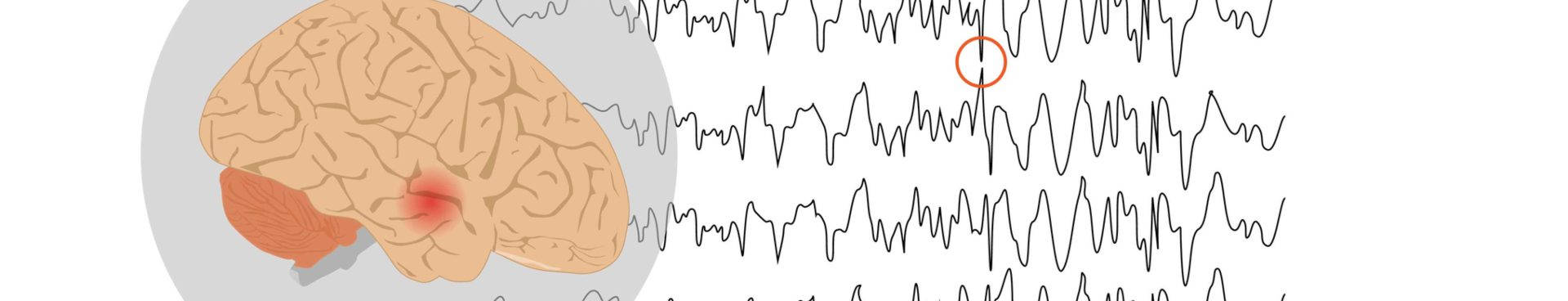 Epilepsia lóbulo temporal