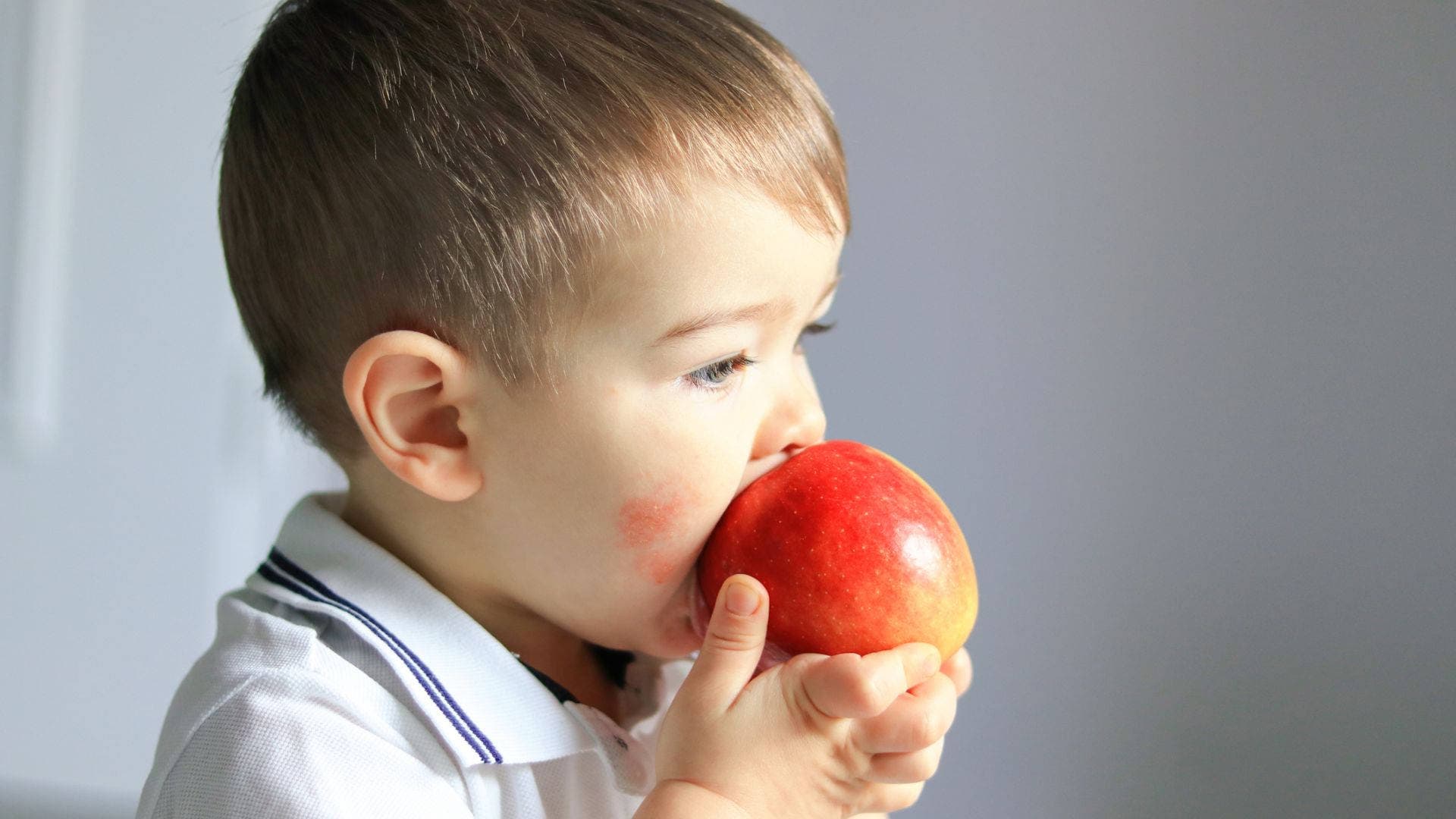 niño con sintomatología cutánea por hipomelanosis de Ito