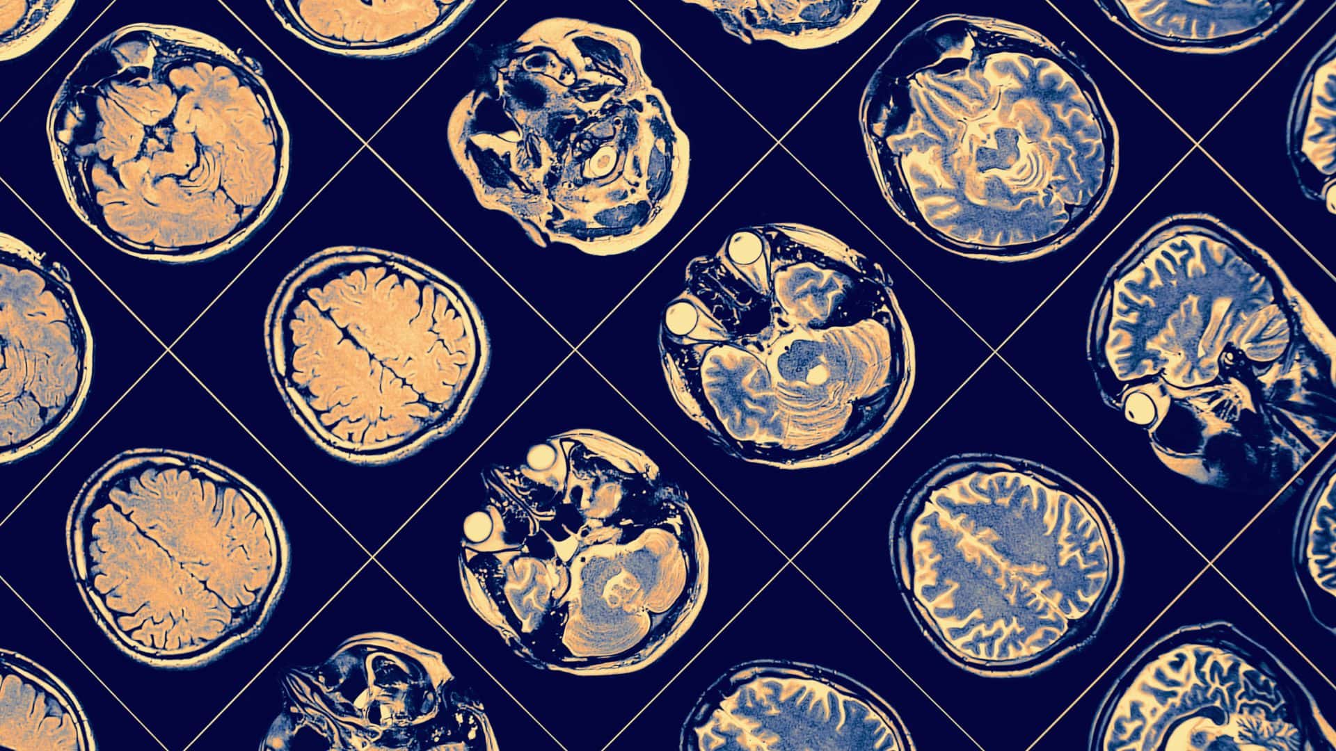 Imágenes de cerebros con párkinson y demencia.