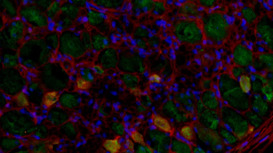 Investigación dolor neuropático Elsa Cisneros UNIR
