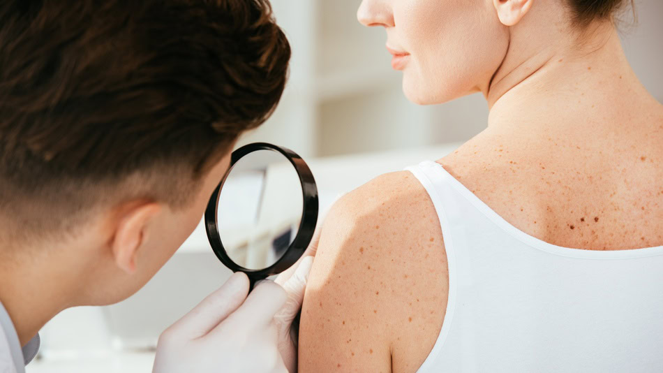 El melanoma es un tipo de cáncer de piel