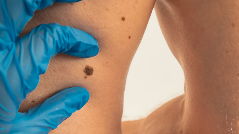 Los factores que aumentan el riesgo de melanoma y de otros tumores cutáneos son diversos