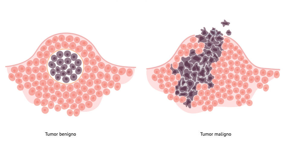 Dibujo de un tumor benigno y un tumor maligno