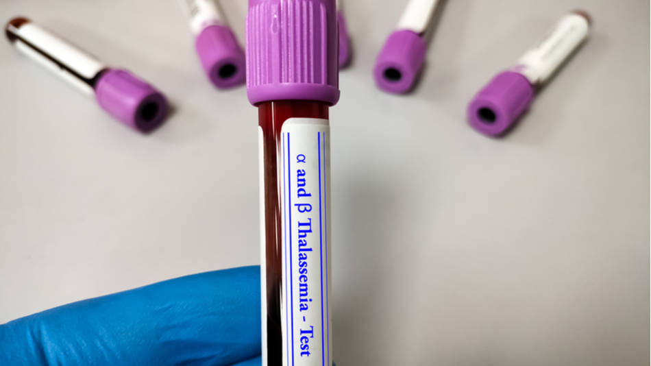 Muestra de sangre con la etiqueta prueba de talasemia alfa y beta