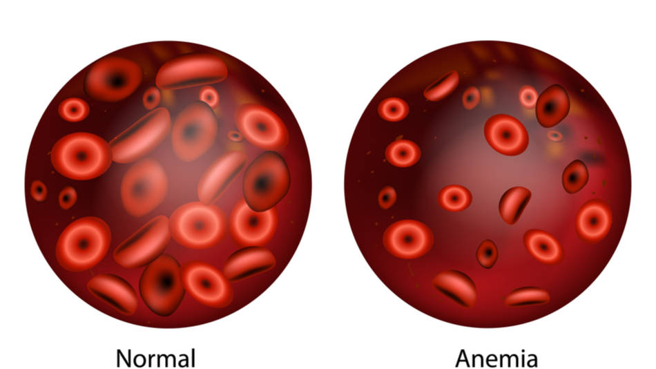 problemas-hematologicos-en-ninos