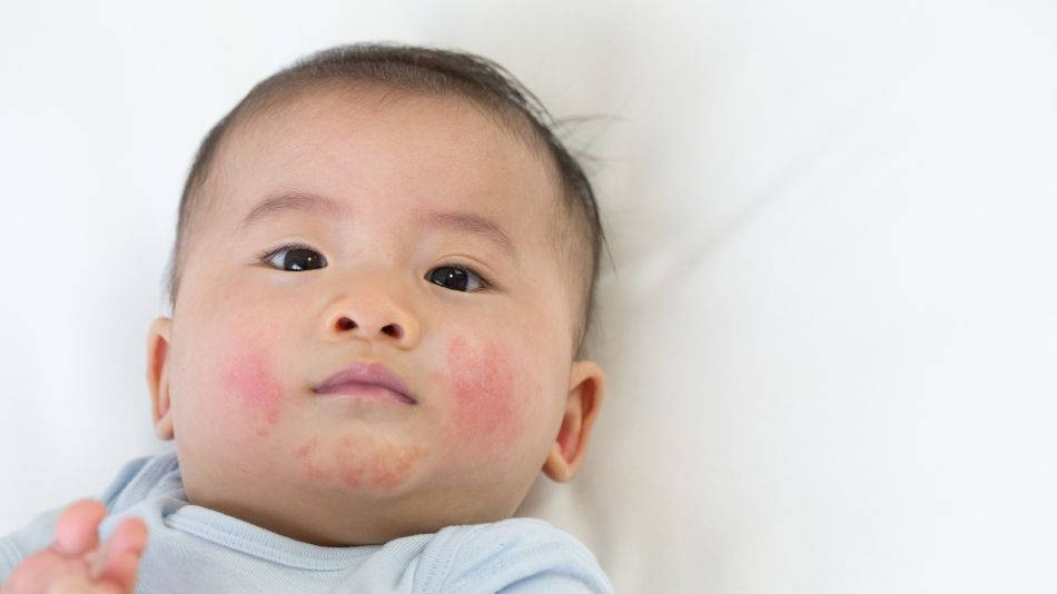 hipomelanosis de ito niño